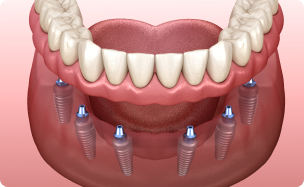 implant răng bao nhiêu tiền Đồng Nai