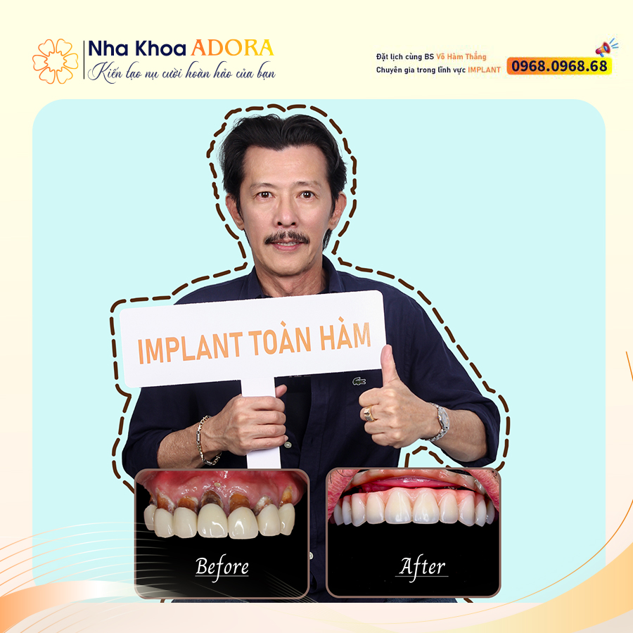 Cấy ghép Implant