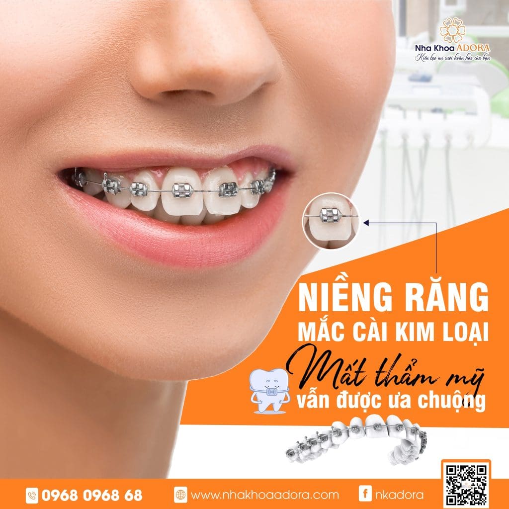 niềng răng mắc cài Đồng Nai