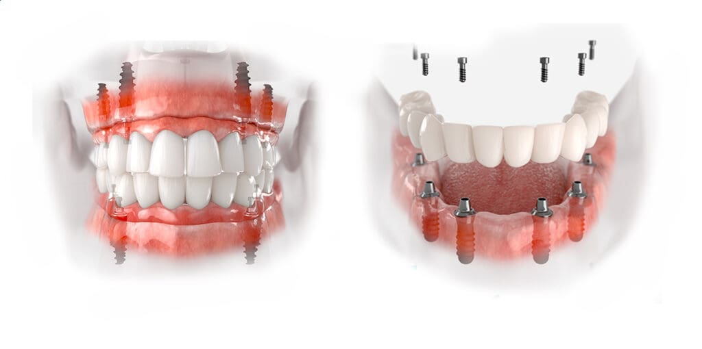 Cấy ghép Implant