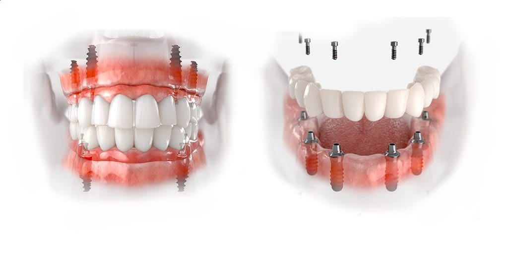 implant răng bao nhiêu tiền Đồng Nai