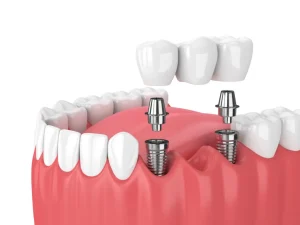Cấy ghép implant đồng nai