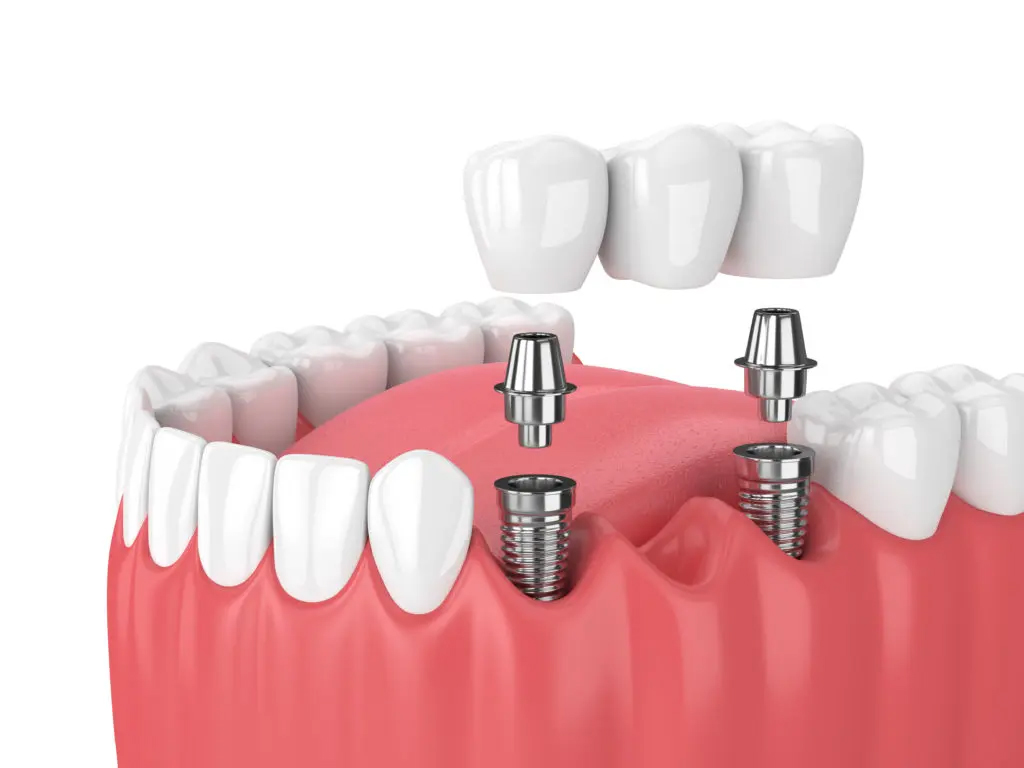 Cấy ghép Implant