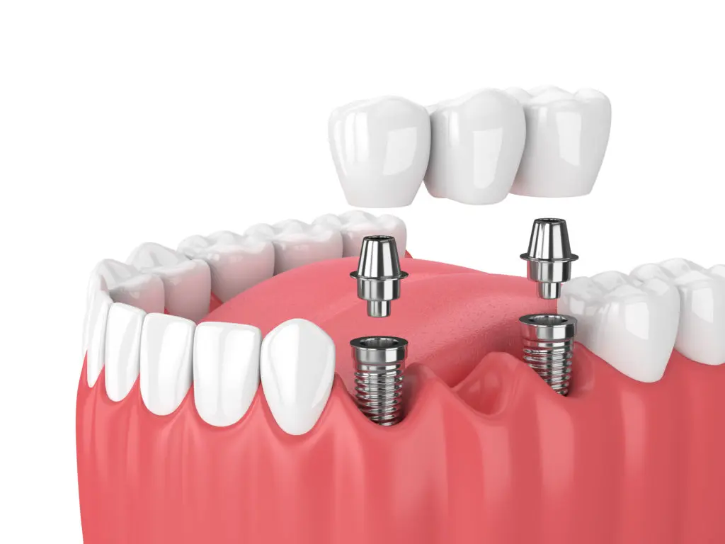 Cấy ghép implant đồng nai