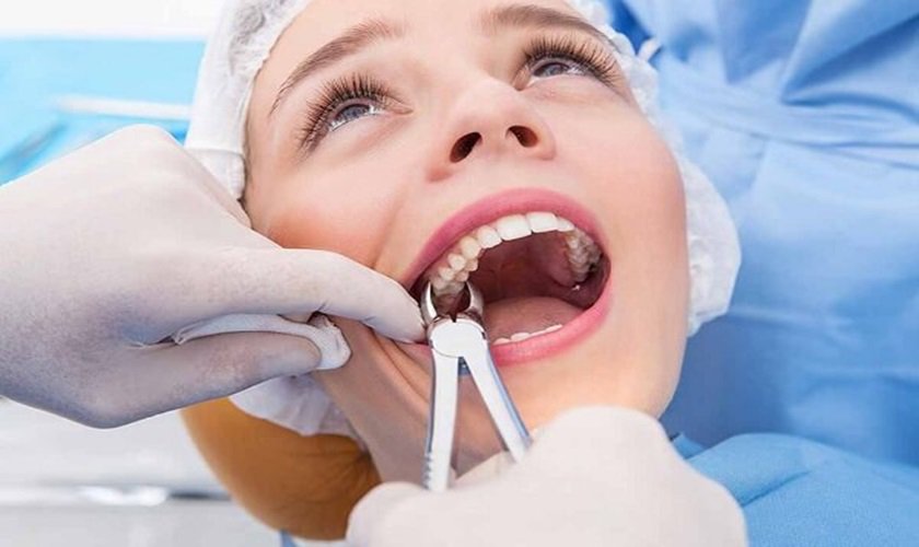 Nhổ răng số 8 Đồng Nai
