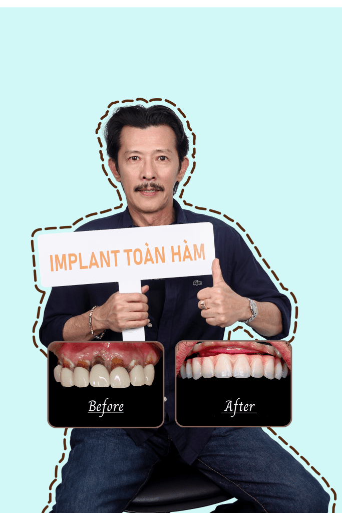 trồng răng đồng nai
