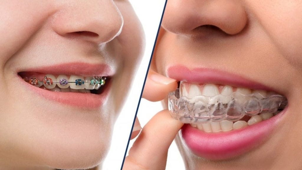niềng răng trả góp Đồng Nai