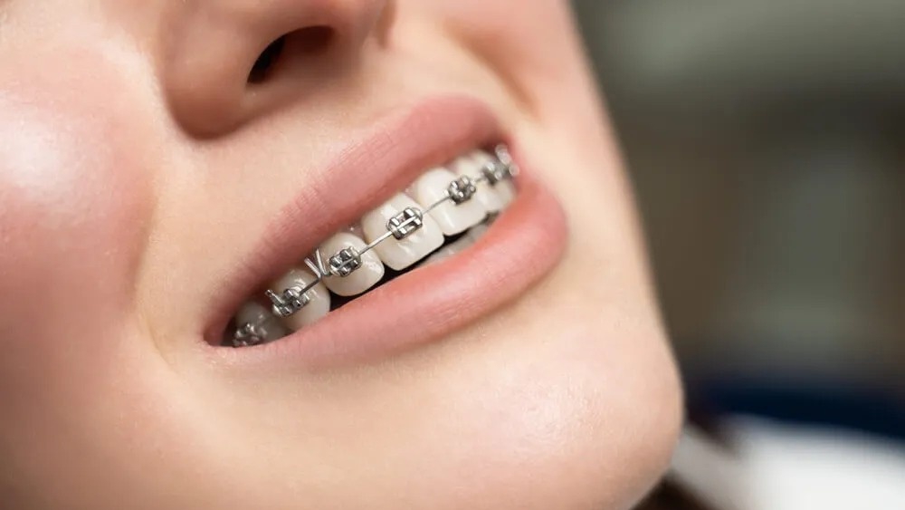 niềng răng mắc cài Đồng Nai