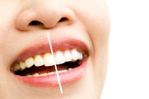 Tẩy Trắng Răng Đồng Nai