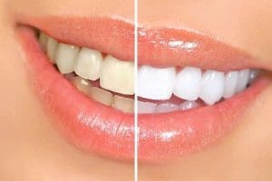 Tẩy Trắng Răng Đồng Nai
