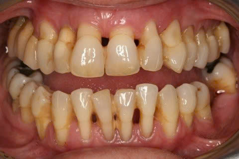 Xỉa Răng Bằng Tăm