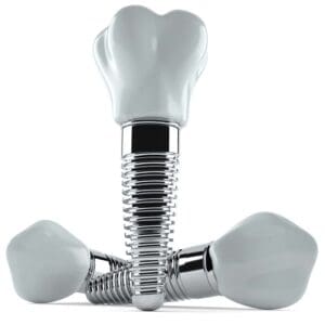 trồng răng implant trả góp Đồng Nai