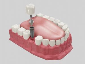 implant nha khoa đồng nai