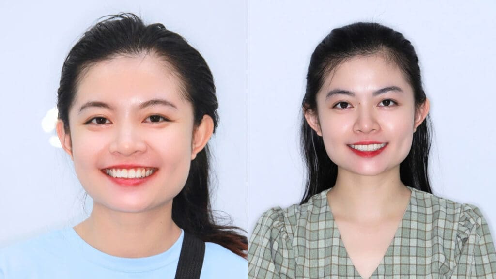 Bọc răng thẩm mỹ Đồng Nai