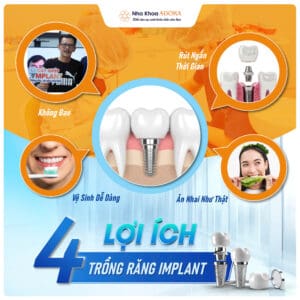 TRỒNG RĂNG IMPLANT